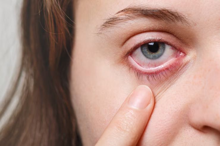 What is eye flu? – आई फ्लू क्या है? कैसे होता है? इसके कारण, लक्षण और उपचार